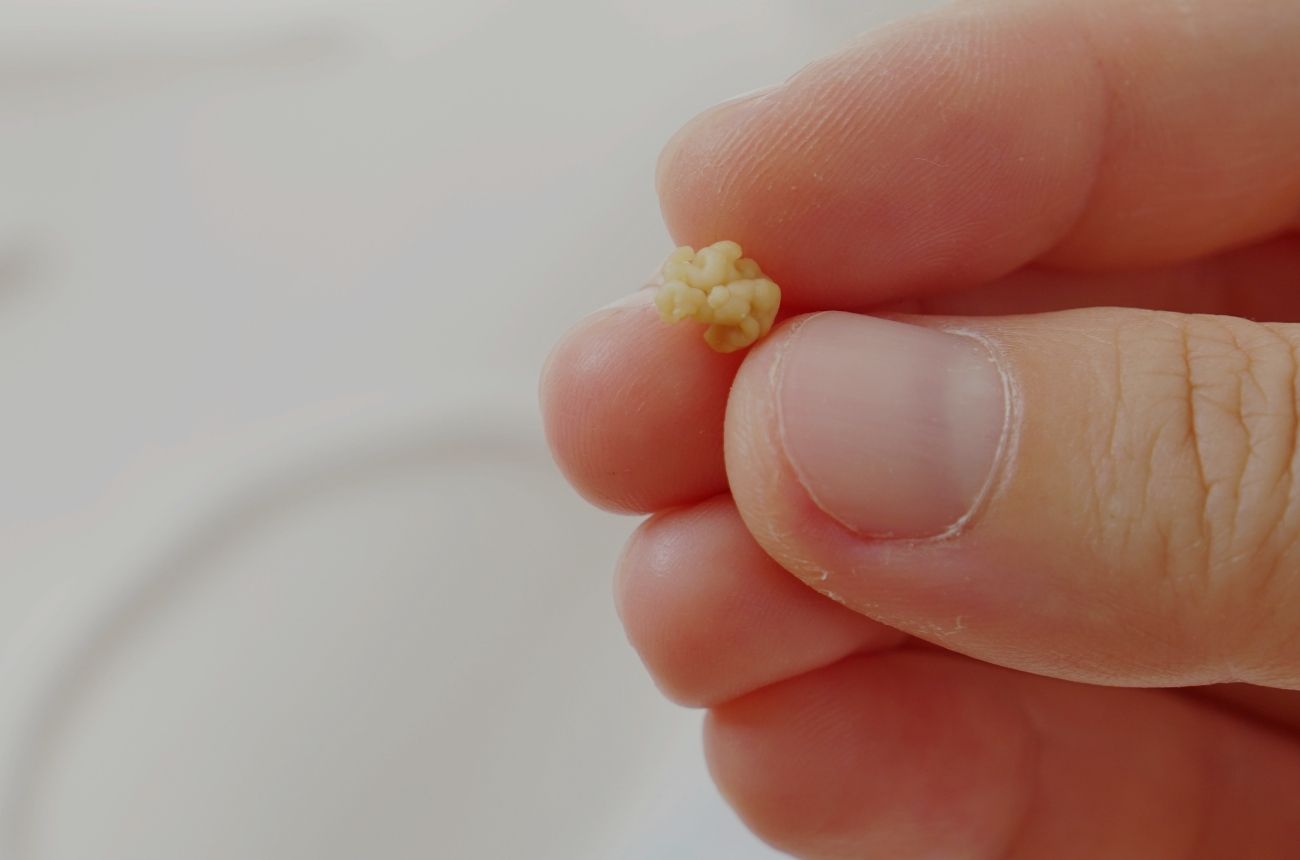 What are Tonsil Stones? Symptoms, Treatment blog.cult.fit